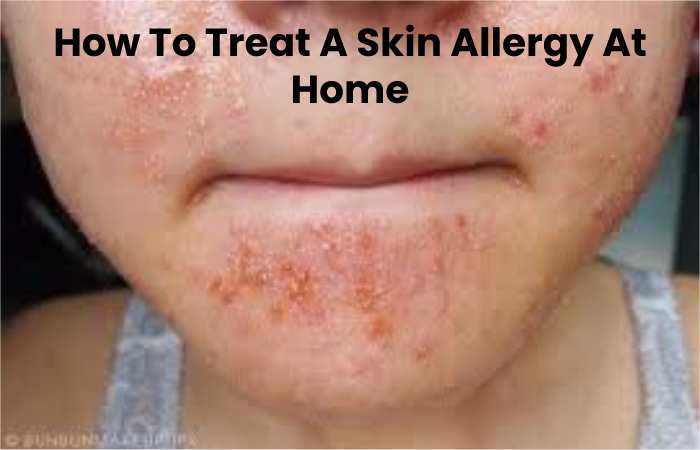 How To Treat A Skin Allergy At Home