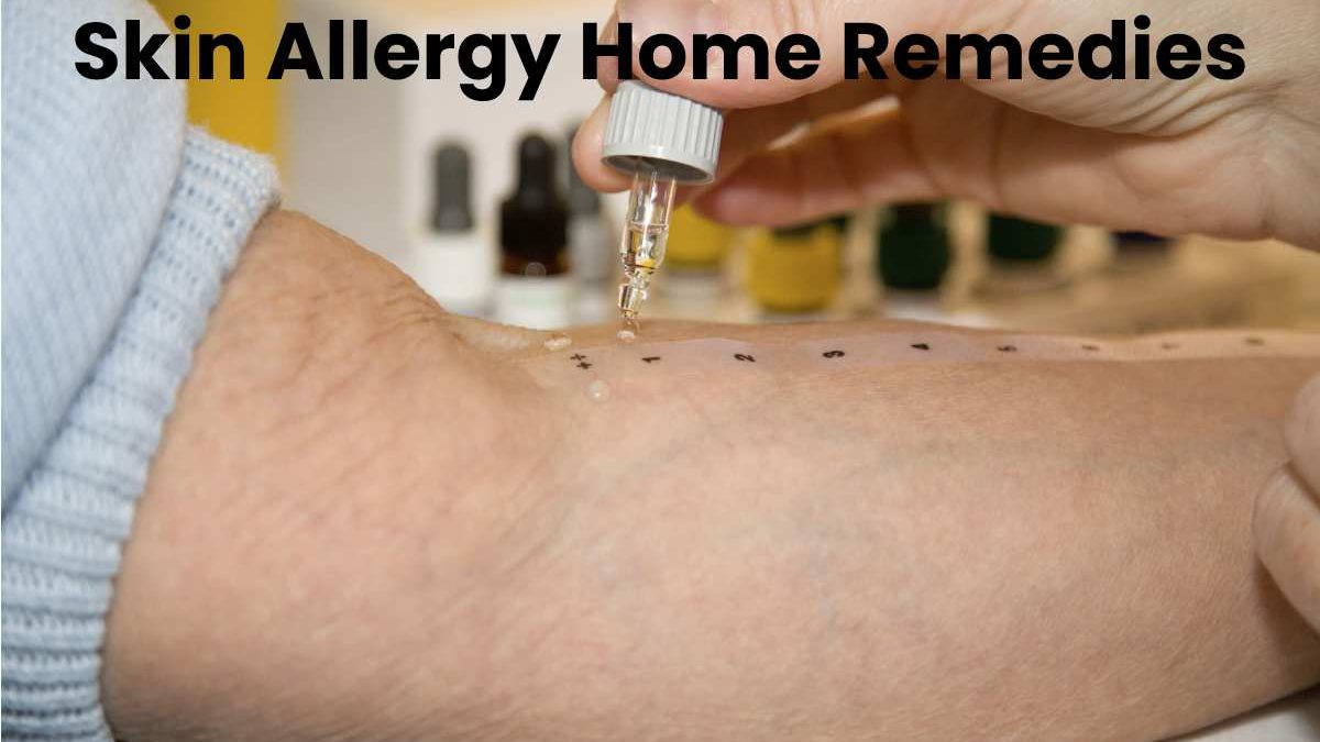 Skin Allergy Home Remedies