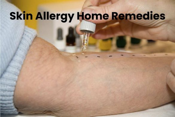 Skin Allergy Home Remedies