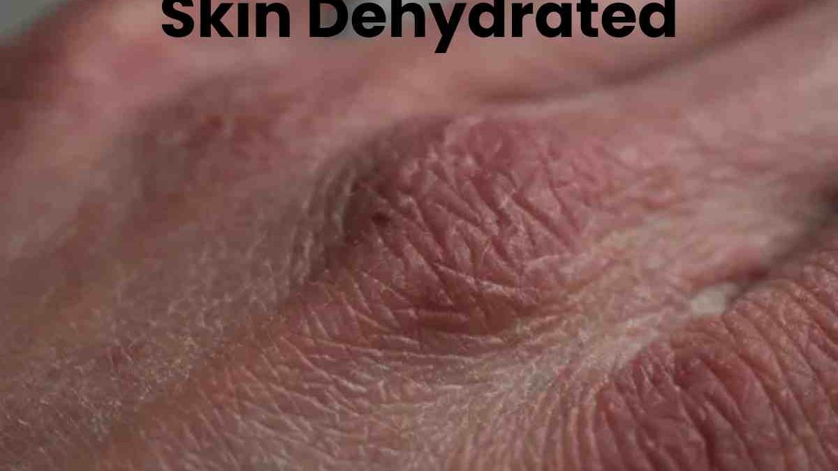 Skin Dehydrated