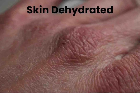 Skin Dehydrated