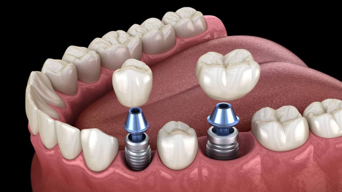 Concerning All-On-4 Dental Implants: Common Misconceptions