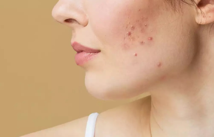 Acne in Women