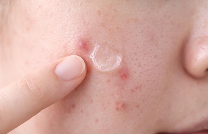 Person applying topical acne gel on facial skin to treat breakouts
