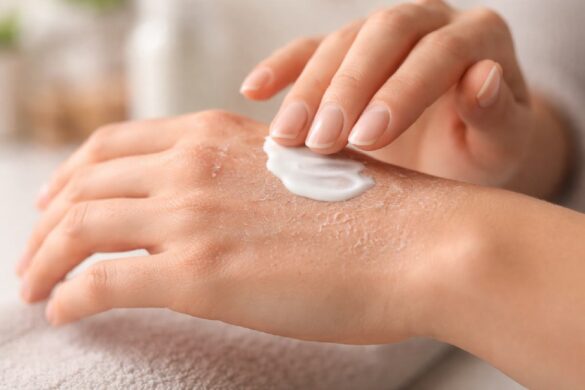 Person applying moisturizer to dry flaky skin on hand
