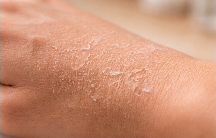 Close-up of flaky rough dry skin texture