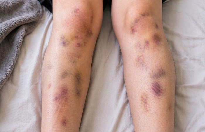 Multiple unexplained bruises on legs
